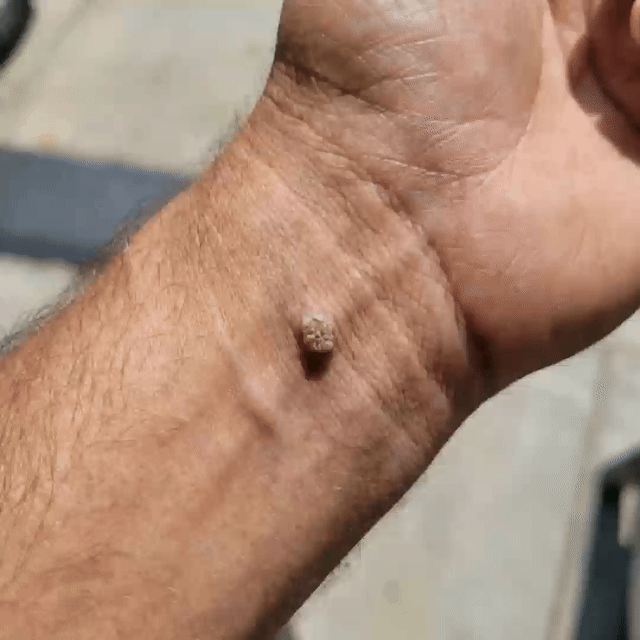 NEXORA® SkinLift — Botanical Microneedle Skin Tag Patch