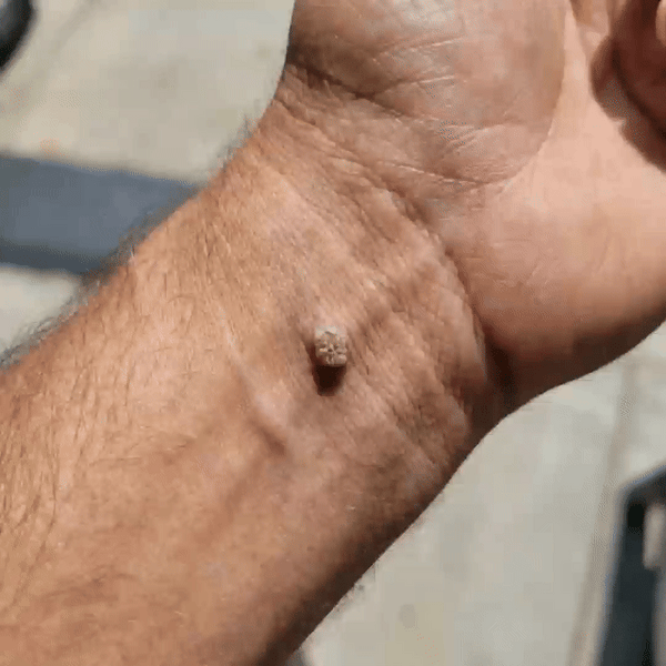 NEXORA® SkinLift — Botanical Microneedle Skin Tag Patch