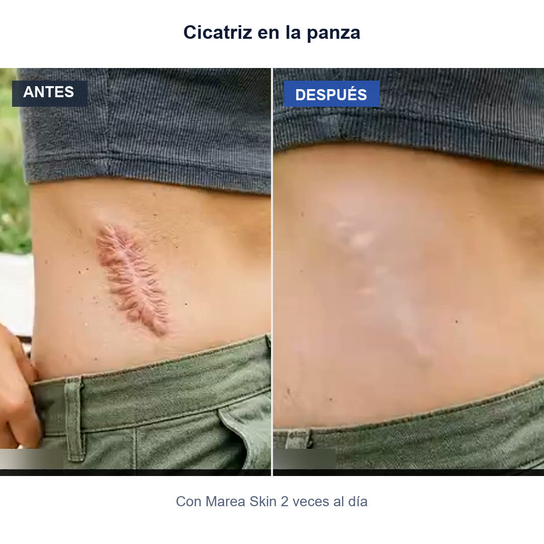 Antes y después: Cicatriz en la panza