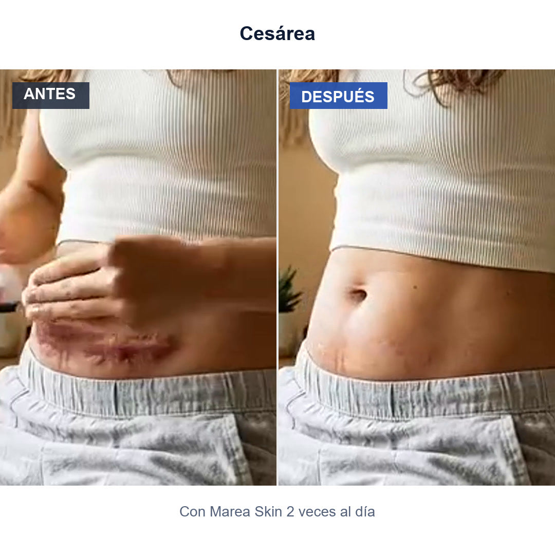 Antes y después: Cesárea