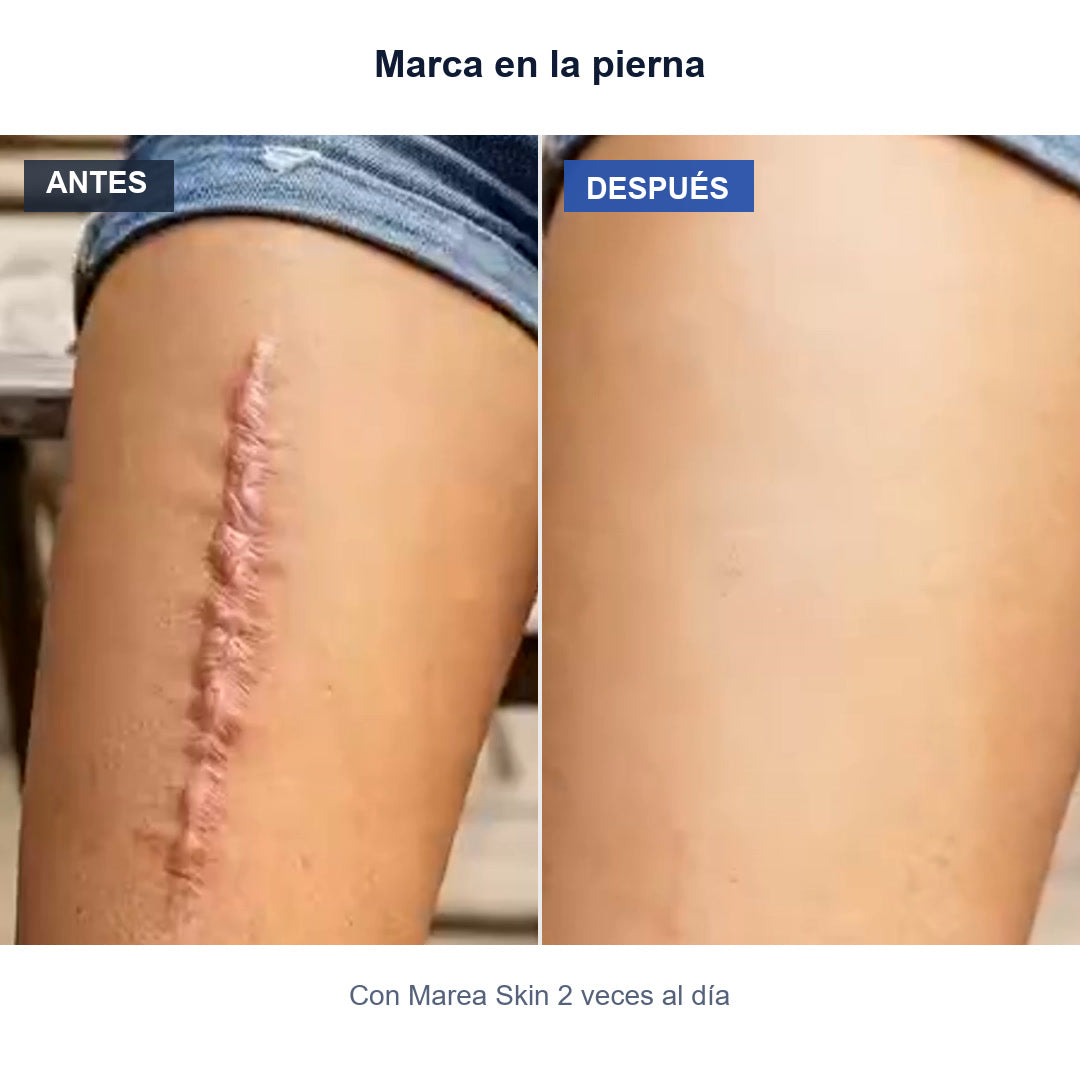 Antes y después: Marca en la pierna