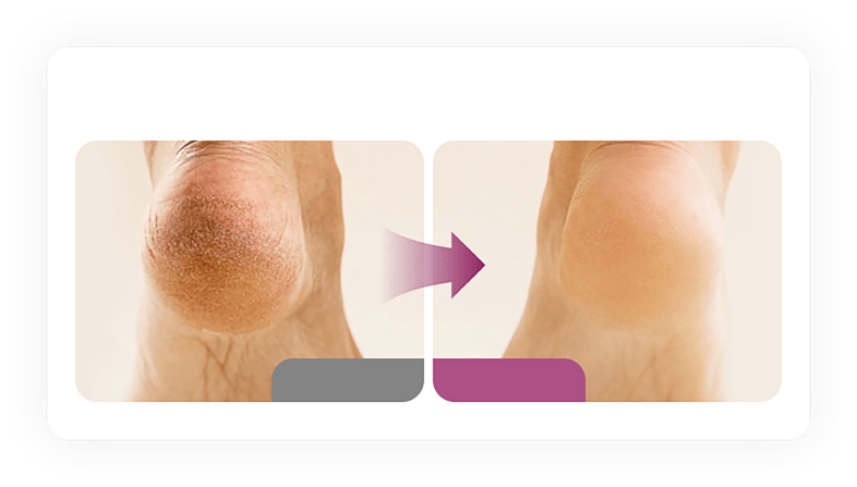 Thick calluses