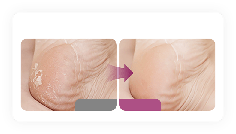 Dead skin buildup