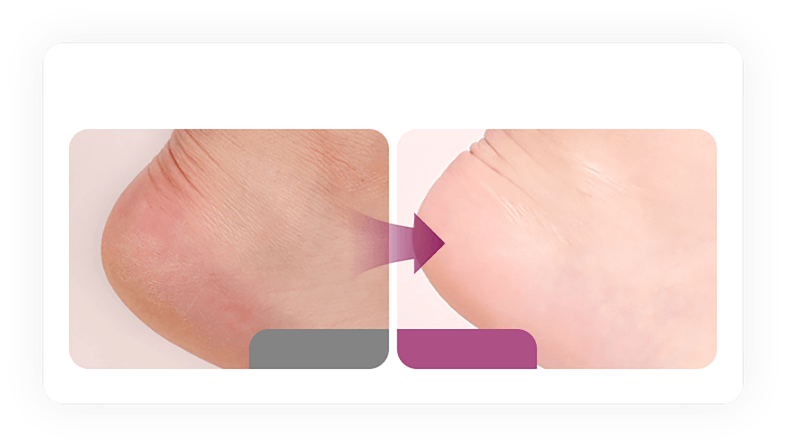 Cracked heel lines