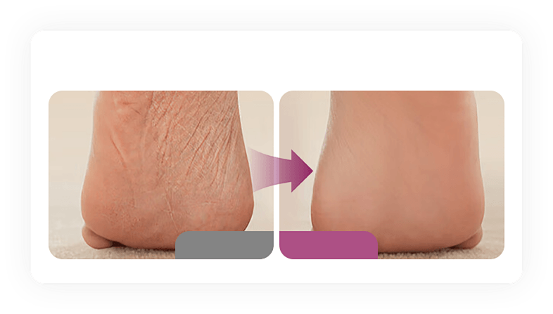 Dry, flaky soles