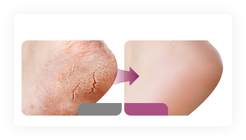 Stubborn dry skin